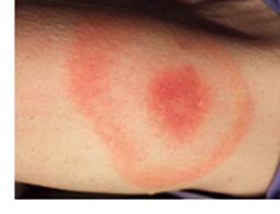 Photo showing ‘bullseye’ rash typical of Lyme Disease.